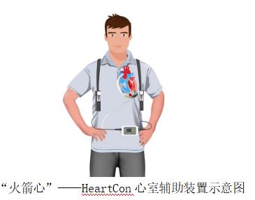 华西医院有了国产的“人工心脏”更小巧轻便