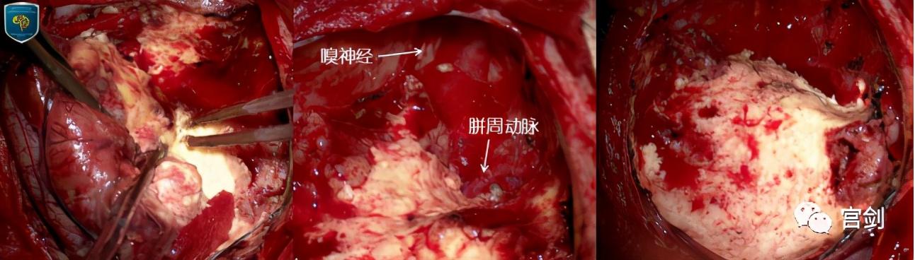 症状性癫痫要及早手术治疗｜附罕见病例报道