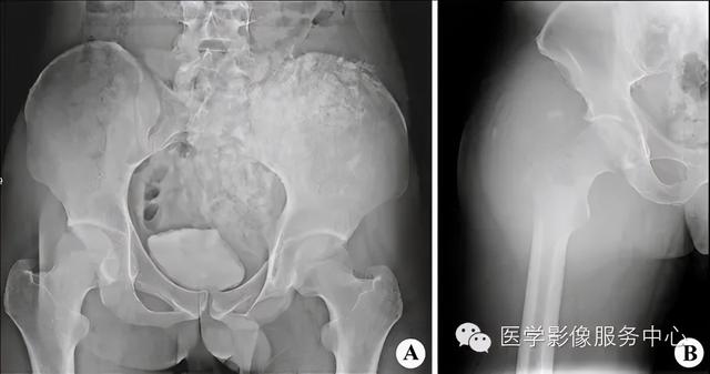 77种骨肌影像病例，助你诊断无忧