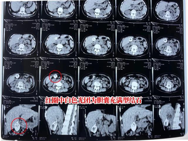 无症状胆结石久拖不治，结果器官、结石竟融为一体变“化石”