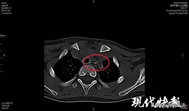 3岁女童食道被卡 取出一看是个“皮卡丘”