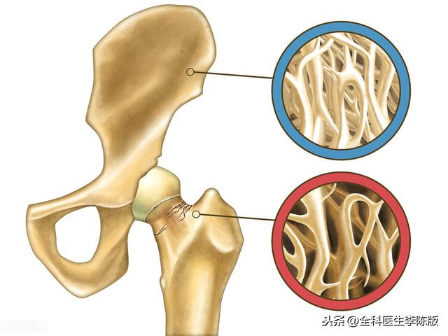 骨质疏松的4个常见误区，稍不注意酿成大错