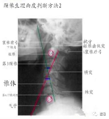 收藏丨手把手教你在X线上如何测量「颈椎生理曲度变直」