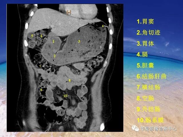 消化道穿孔的CT诊断