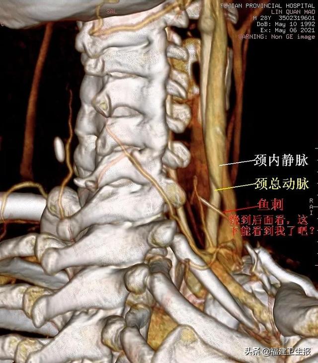 鱼刺|福州小伙吞鱼刺后忘了，2年后他的脖子肿起一个大包……