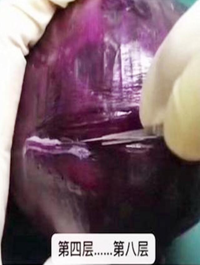 你的育儿经|选剖腹产不疼？这根10厘米的麻醉针仅仅是开始，疼到你怀疑人生