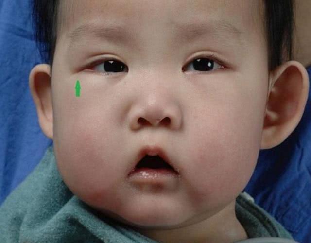 [你的育儿经]太漂亮也不好？宝宝天生自带“眼妆”，竟是一种罕见病？