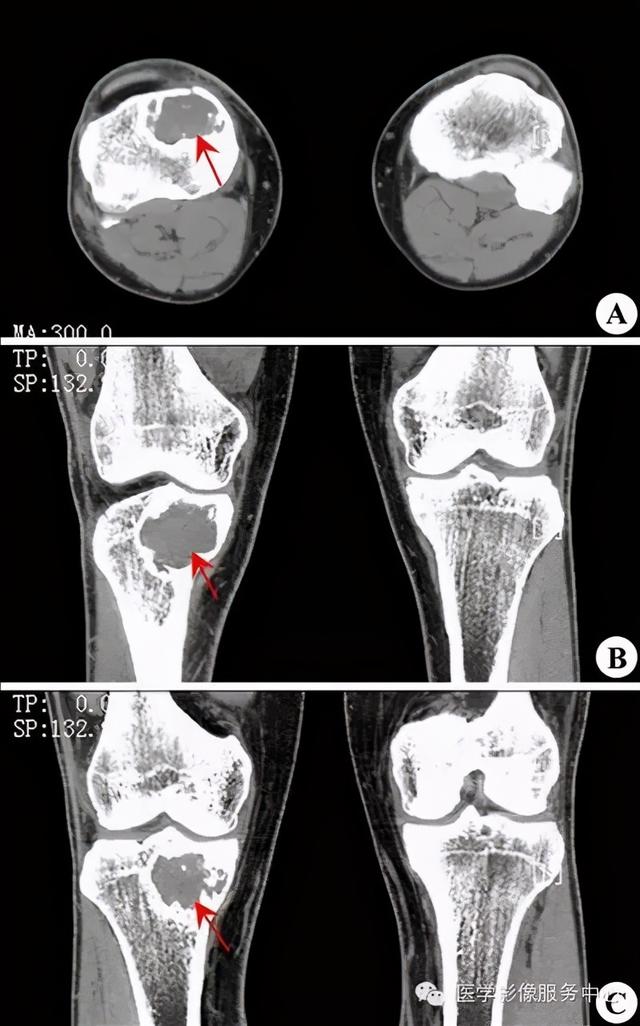 77种骨肌影像病例，助你诊断无忧