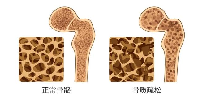 给“口重”的人提个醒：你可能已经在「骨质疏松」的边缘了……