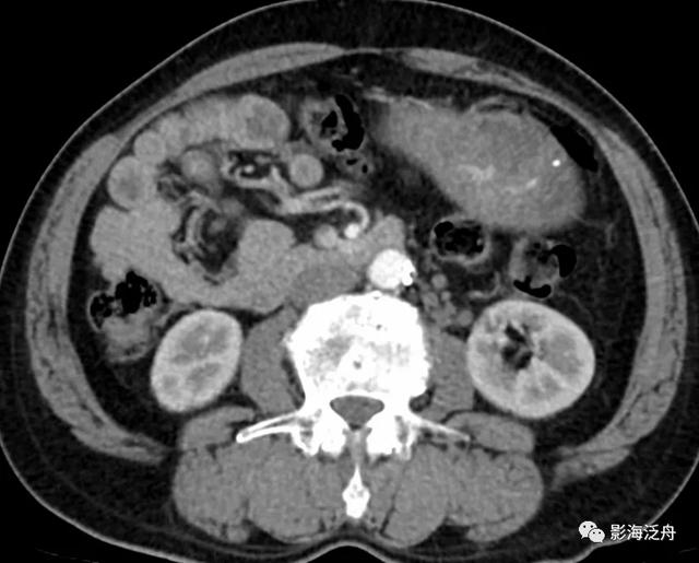 这个病，腹部CT经常会漏诊