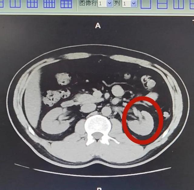 神秘“消失”的肾结石