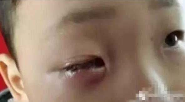你的育儿经■短短20分钟，孩子眼珠似冰雪般融化，家长不当心转眼成千古恨
