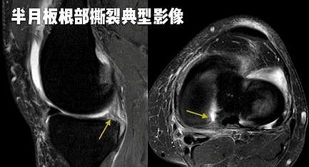 为什么半月板撕裂后，膝盖会“滋啦”响？该咋办，医生给您讲清楚