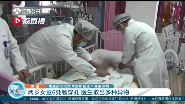 两岁女童误食致6处肠穿孔 医生手术取出15颗磁力珠、2颗钢珠及1枚螺钉