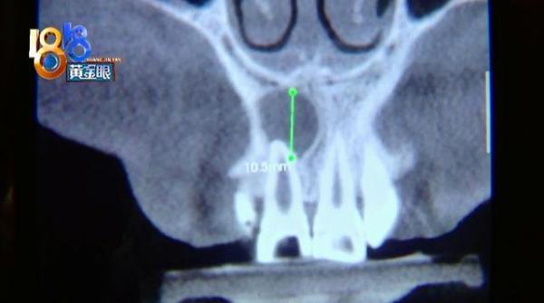 小杜|拍片没发现“囊肿”，四颗牙要缺一年？