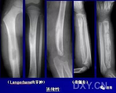 9个骨肿瘤医学影像诊断分析基本要点，如此精彩怎能错过
