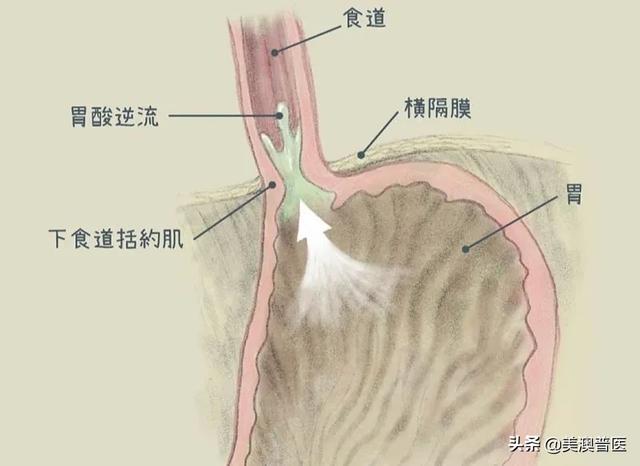 经常反胃酸、火烧心？经常吃这些食物，最容易患胃食道逆流！