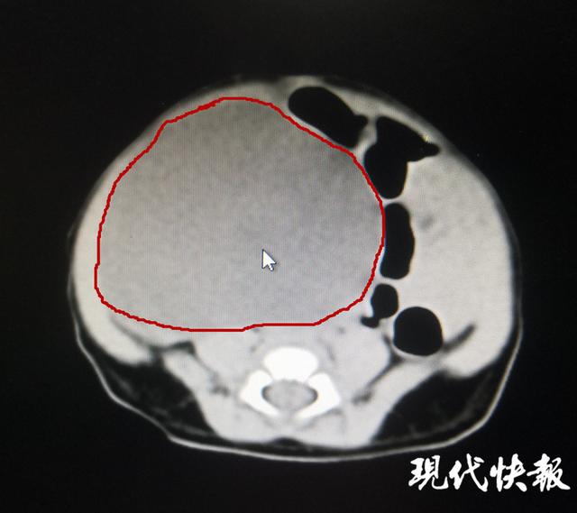 新生宝宝患卵巢囊肿，产检时就发现了