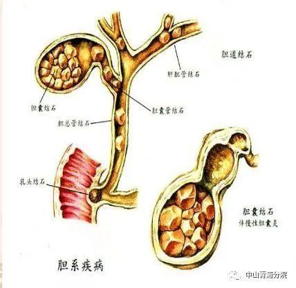 胆囊|看完这篇，你就明白胆结石是怎么回事了