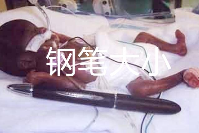 #天使宝贝#世界最小婴儿怎样了,出生时仅有苹果大小,现状令很多人“满意”