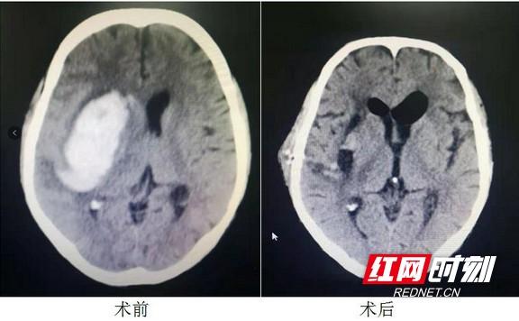 手术|工人突发脑溢血偏瘫 湖南航天医院微创手术助其成功站起来