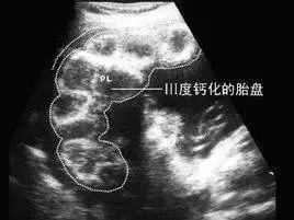 超级宝妈@补钙会使胎盘钙化？医生：两者没有任何关系
