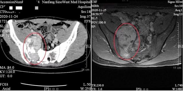 腿麻竟是肿瘤所致 10小时手术切除肿瘤、重建腰骶骨盆