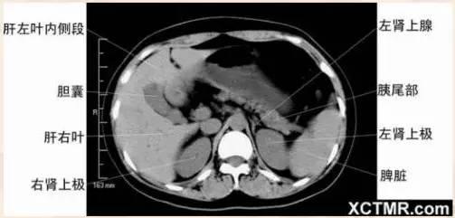 影像解剖：胸、腹部、盆腔CT解剖