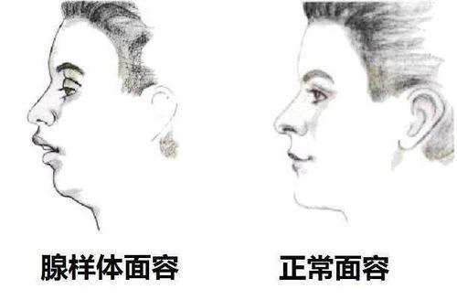 父母高颜值，孩子却越长越丑？先别往别处想，这可能是病