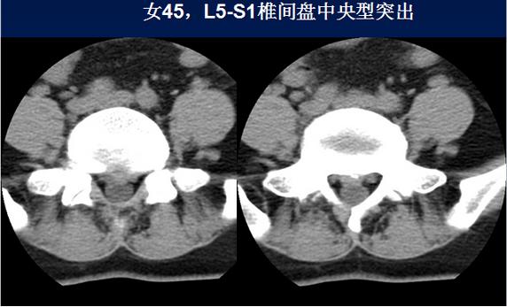 腰椎间盘CT诊断：椎间盘膨出、突出、椎管狭窄及退行性病变