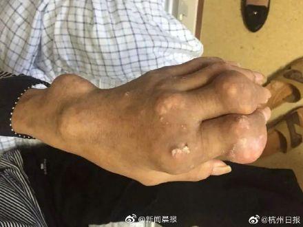 李先生|男子酗酒长满痛风石截瘫 医生：要是早些接受治疗就好了