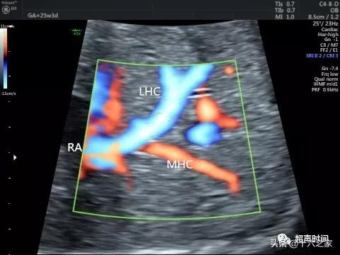 你的育儿经|胎儿下腔静脉缺如