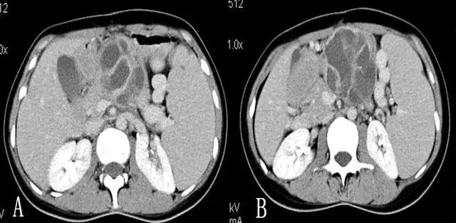 胰腺占位 CT 片不会看？这里一文教你掌握