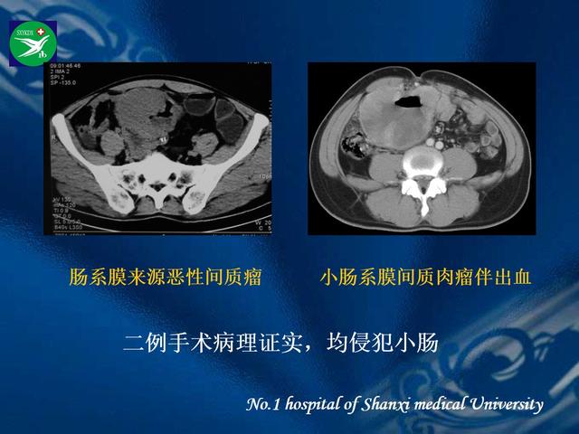 李健丁教授：胃肠道外间质瘤的CT表现和临床病理分析