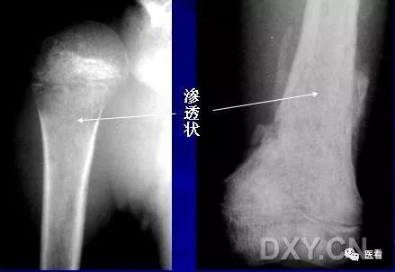9个骨肿瘤医学影像诊断分析基本要点，如此精彩怎能错过