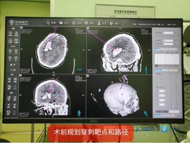 血肿|多年高血压患者突发头痛致偏瘫 立体定向机器人技术重燃他站起来的希望