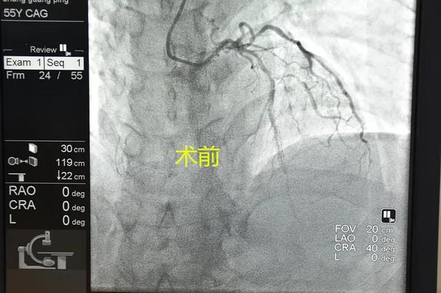 重磅！心脏冠脉支架7500元降至590元，在宝鸡高新医院率先执行