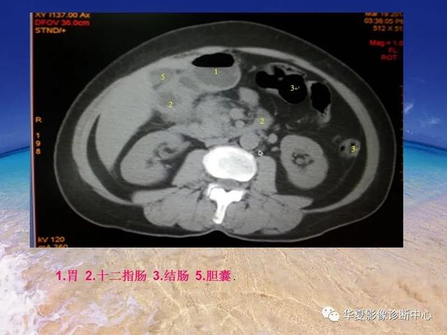 消化道穿孔的CT诊断