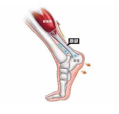 滤器|跟腱断裂躺平养伤 小伙惹上肺栓塞