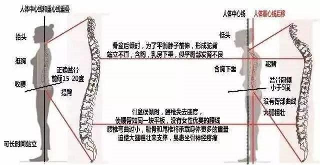 非特异性|有一种腰痛是因为屁股不够翘