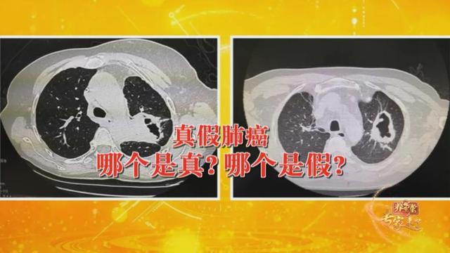 肺脓肿|“假肺癌”可能引发全身中毒、 肺部大出血！老年人和糖友需警惕
