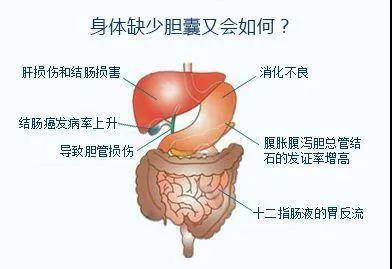 胆结石患者慕名而来，微创“保胆取石”满意而归