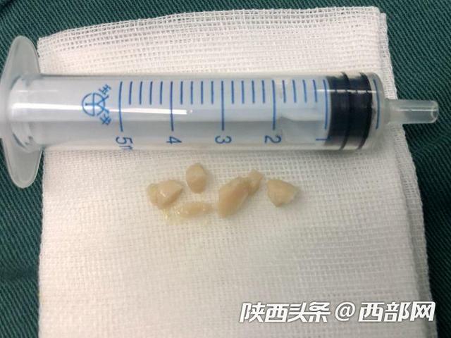 西部网：1天内收治18例异物吸入患者 一岁九个月宝宝因半颗花生险丧命