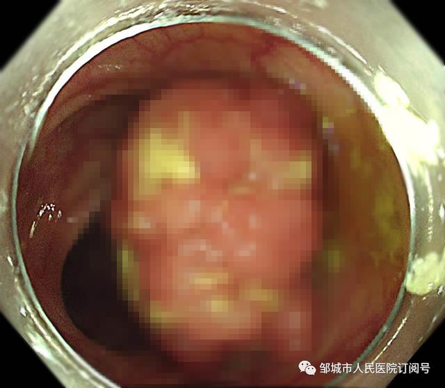 「诊疗动态」邹城市人民医院超微创手术解除患者病痛