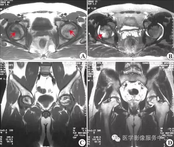 收藏 |：79种典型骨肌影像病例，助你诊断无忧