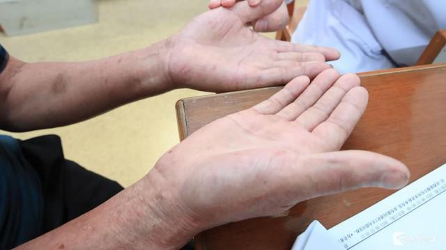 肝脏|看手掌可以查肝病？这个说法你听过吗？