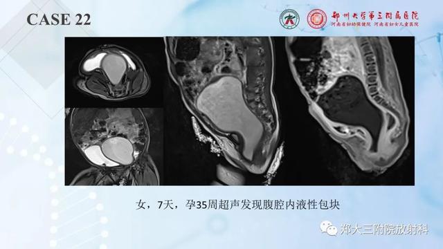 儿童腹部囊性病变诊断思路分析