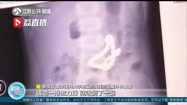 【超级宝妈】祸从口入！3岁男童吞了41颗磁力珠 医生紧急手术救命