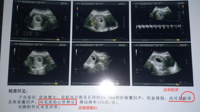 「你的育儿经」整个孕期做几次B超检查、分别多少周做？这有一份攻略，孕妈收藏