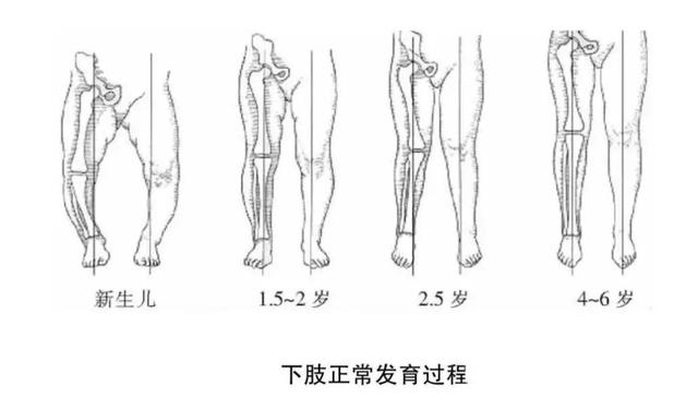 X型腿、O型腿，尽早矫正还来得及